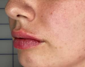 Lip Filler