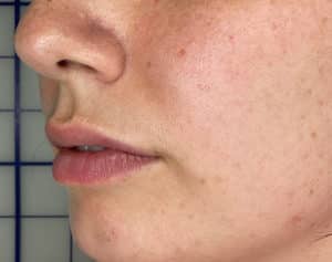 Lip Filler