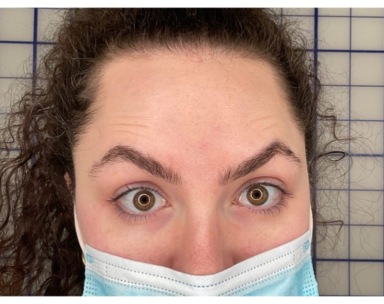 After Image: Botox - front