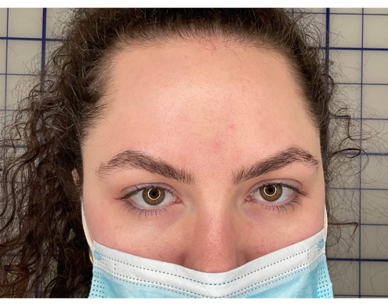 After Image: Botox - front