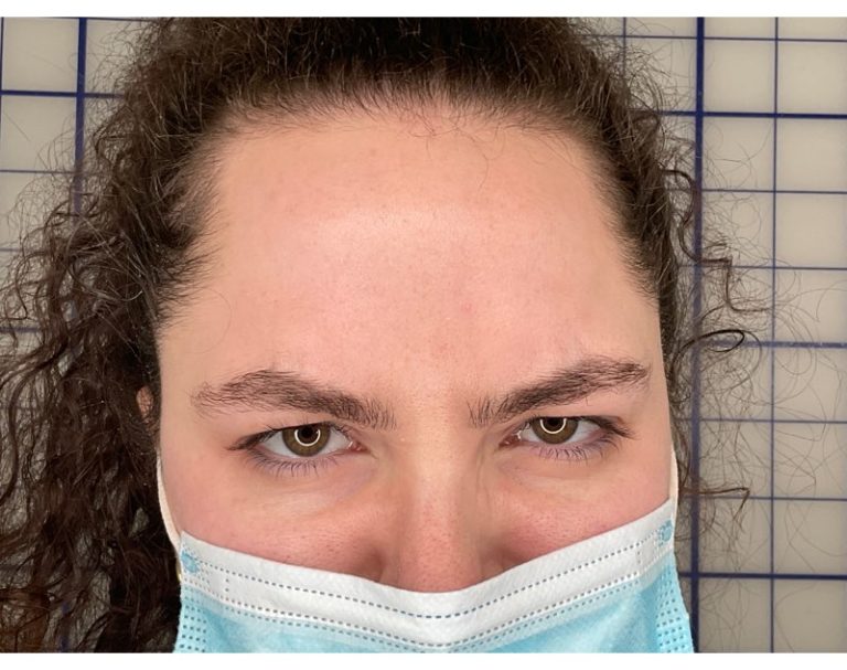 After Image: Botox - front
