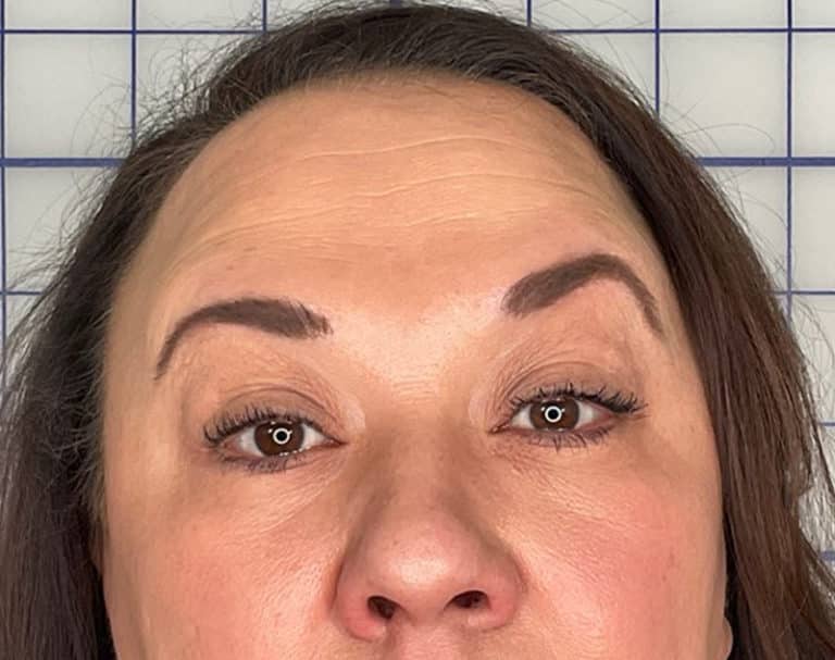 After Image: Botox - front