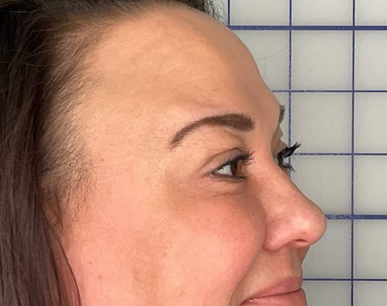 After Image: Botox - right-side