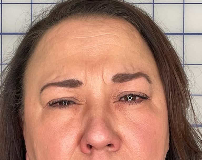 After Image: Botox - front