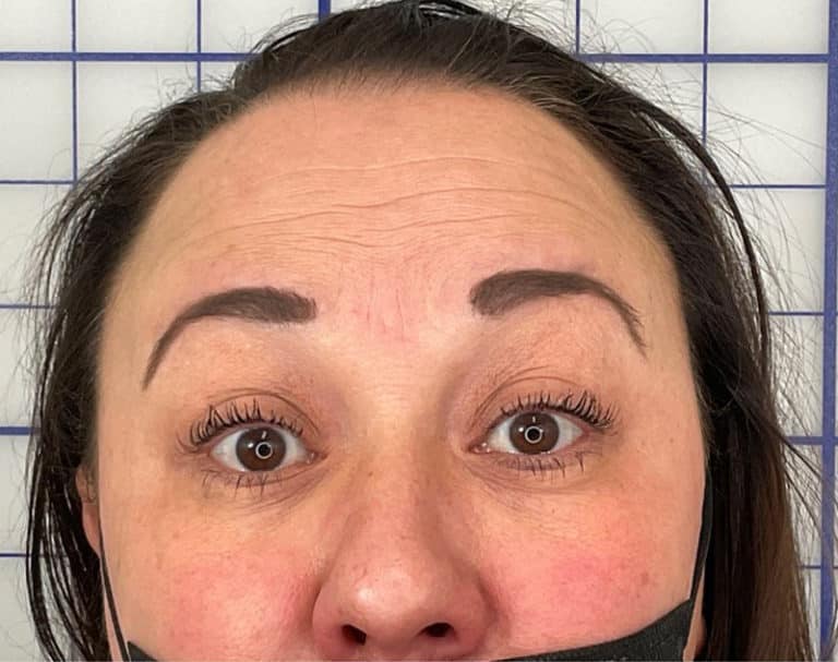 Before Image: Botox - front