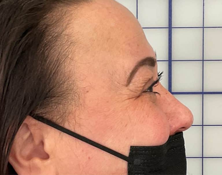 Before Image: Botox - right-side