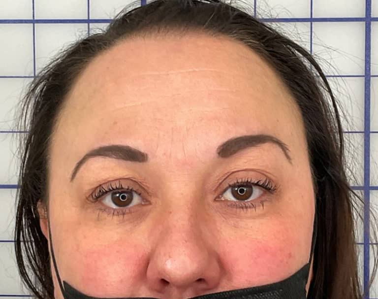 Before Image: Botox - front