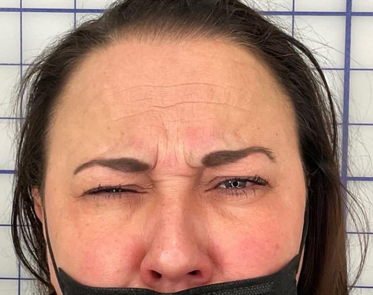 Before Image: Botox - front