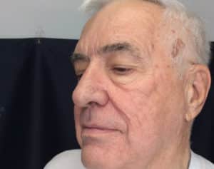 After Image: Erbium and PicoSure