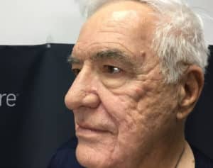 Before Image: Erbium and PicoSure
