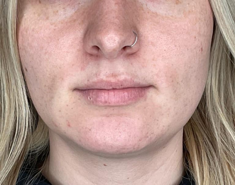 Before Image: Lip Filler - front