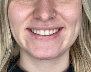 Lip Filler