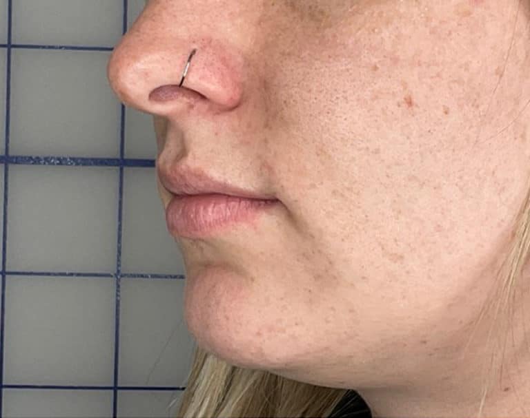 Before Image: Lip Filler - left-front-oblique