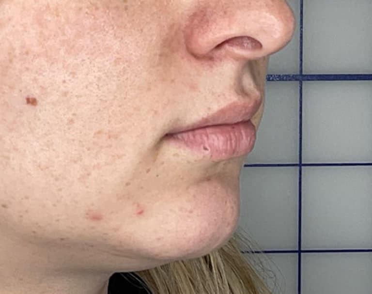 Before Image: Lip Filler - right-front-oblique