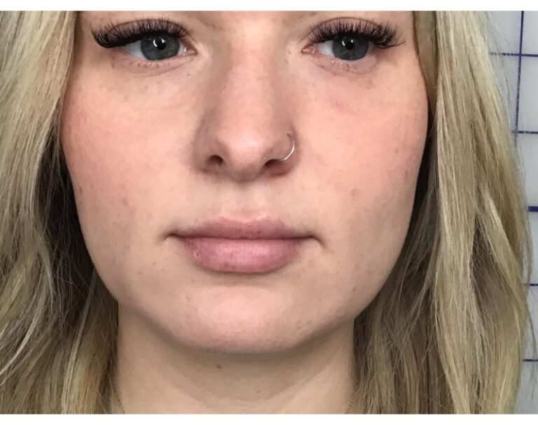 After Image: Lip Filler - front