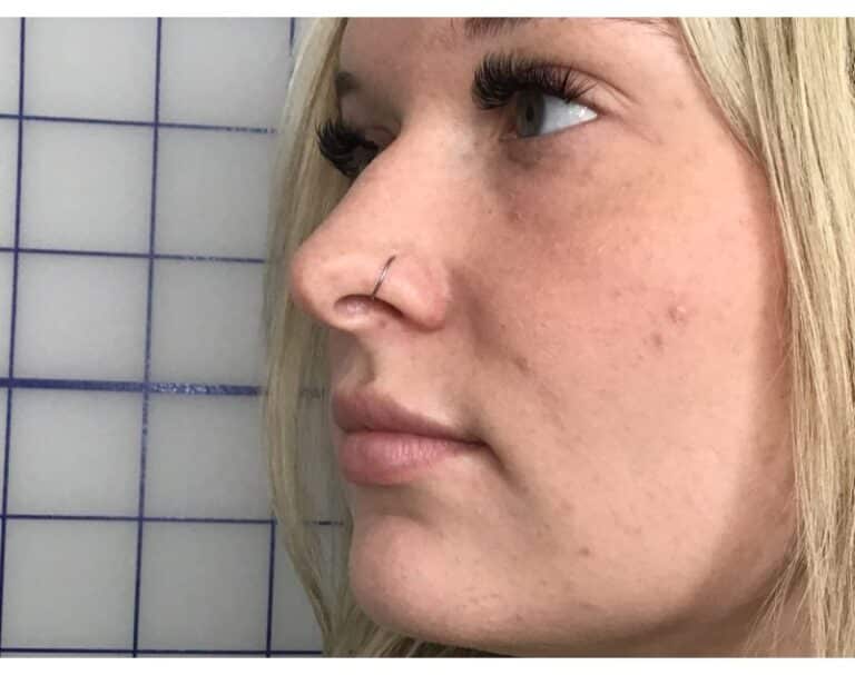 After Image: Lip Filler - left-front-oblique