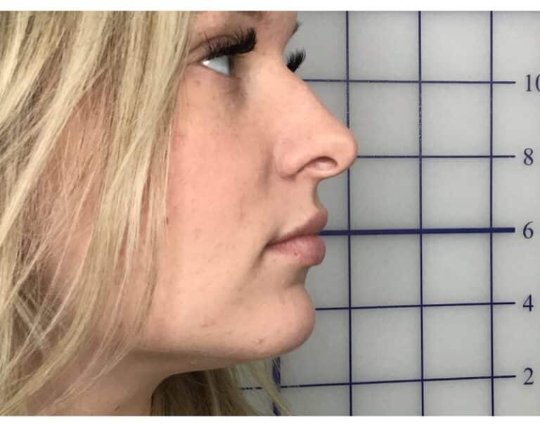 After Image: Lip Filler - right-front-oblique