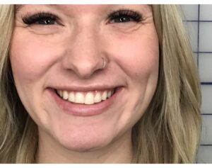 Lip Filler