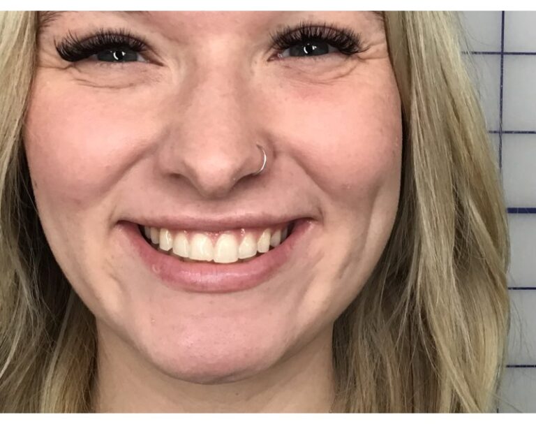 After Image: Lip Filler - front