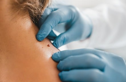 close up of dermatologist examining patient birthmark in clinic picture id1266812413