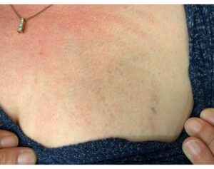 After Image: Tattoo Removal