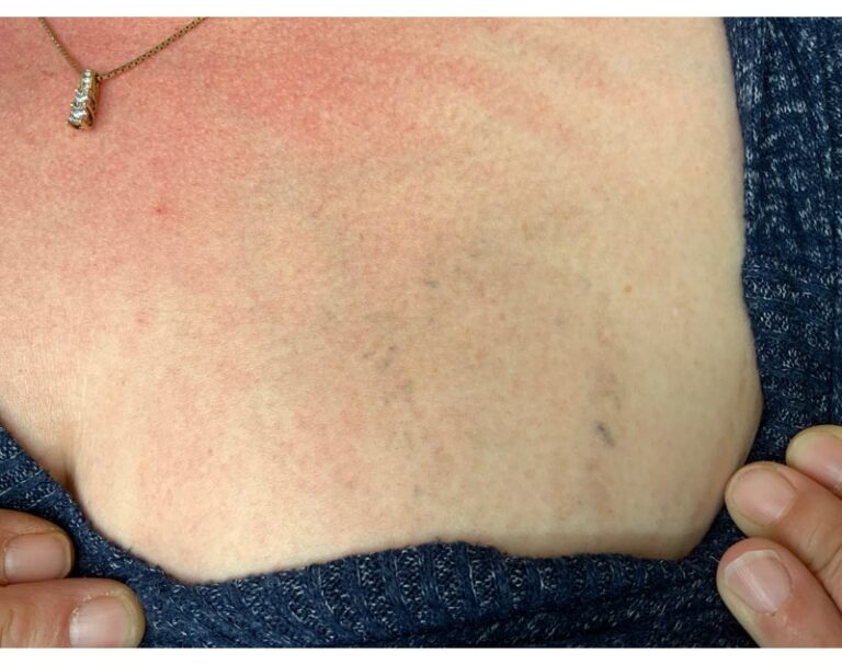 After Image: Tattoo Removal - front