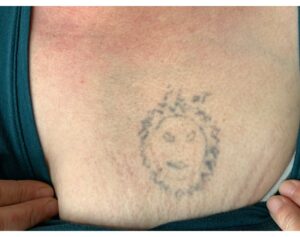 Before Image: Tattoo Removal