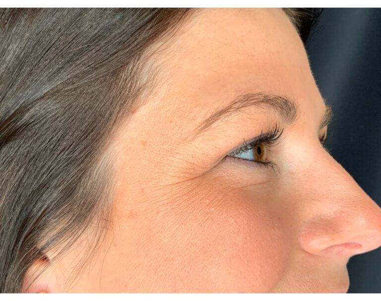 Before Image: Botox - right-front-oblique