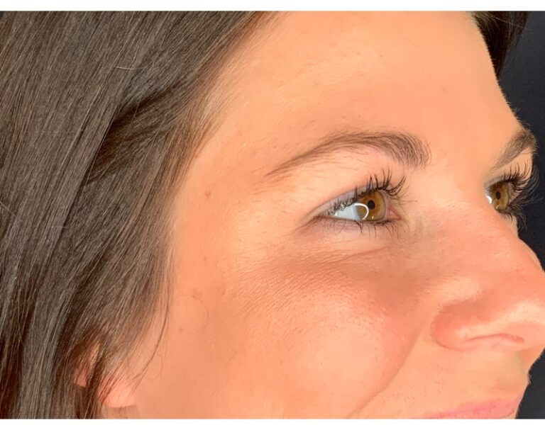 After Image: Botox - right-front-oblique