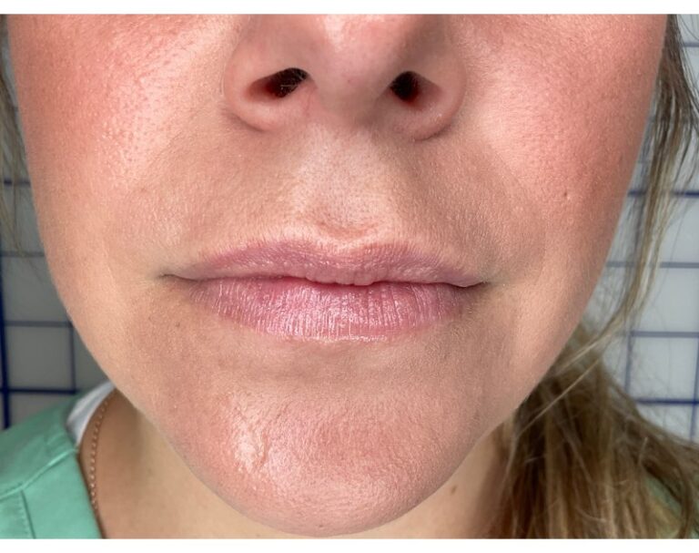 After Image: Lip Filler - front