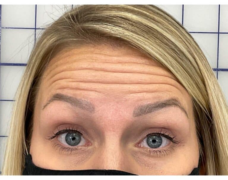 Before Image: Botox - front