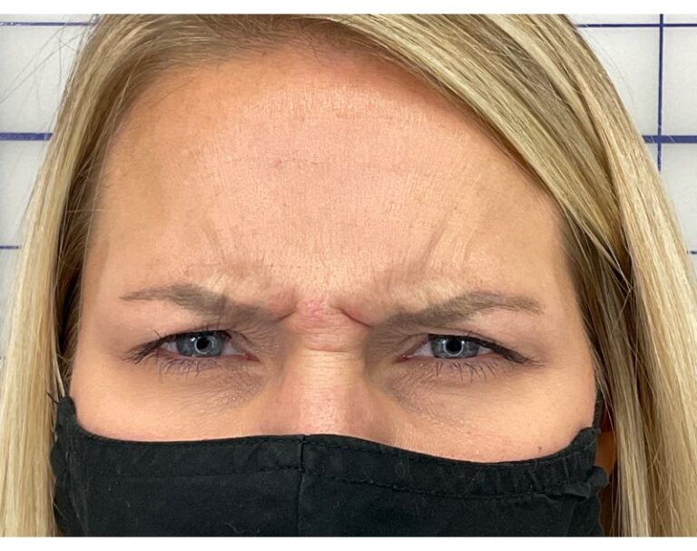 Before Image: Botox -