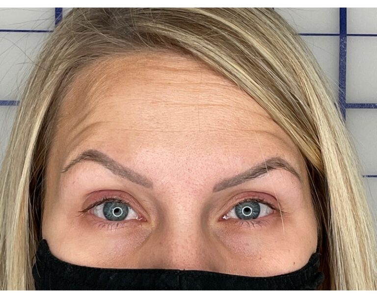 After Image: Botox - front