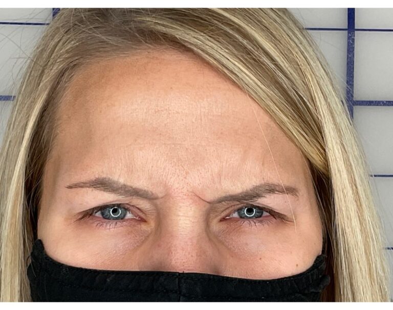 After Image: Botox -