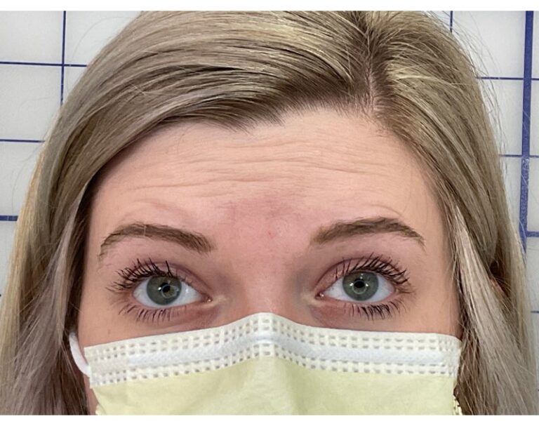 Before Image: Botox - front