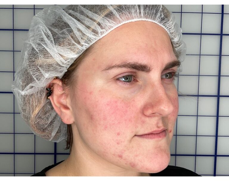 Before Image: Dermatology Care & Cosmetic Treatment - right-front-oblique