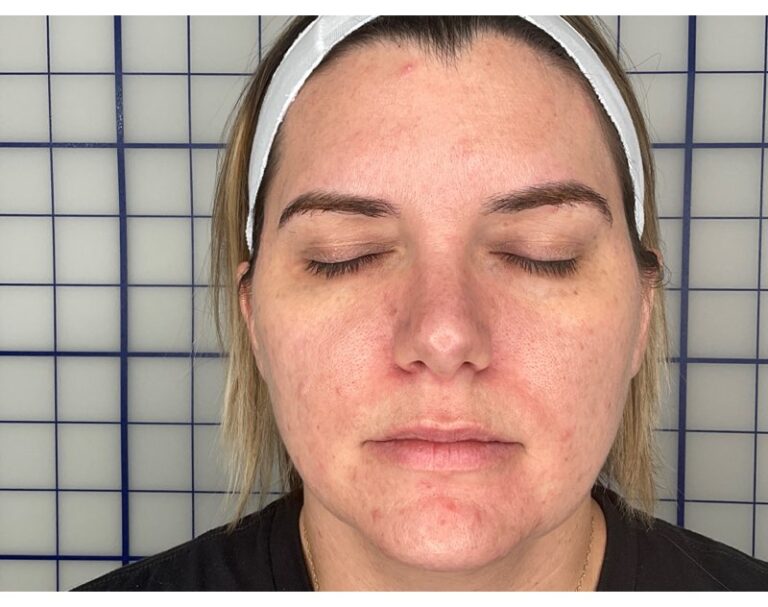 Before Image: Combination Treatments - front