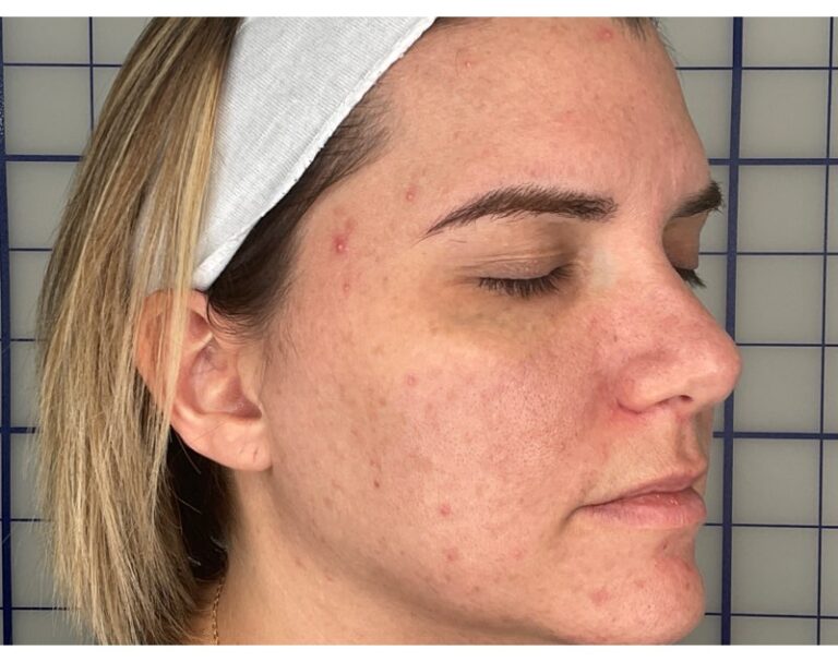 Before Image: Combination Treatments - right-front-oblique