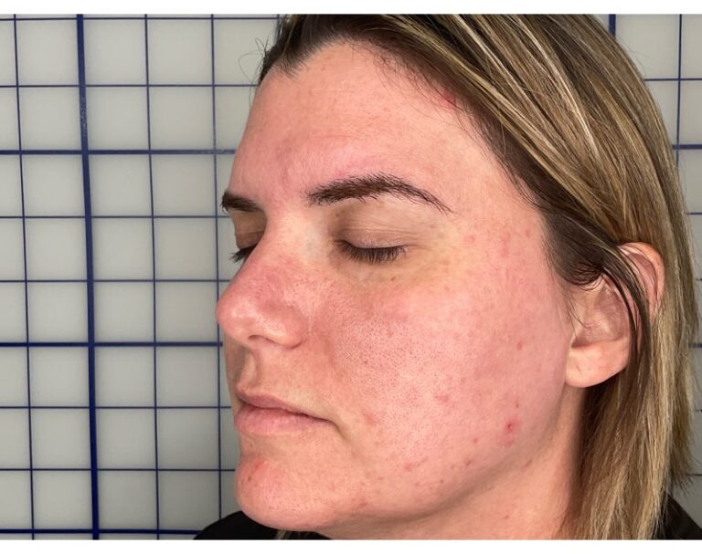 Before Image: Combination Treatments - left-front-oblique