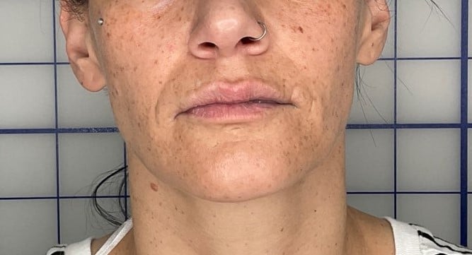 Before Image: Smile Line Fillers - front