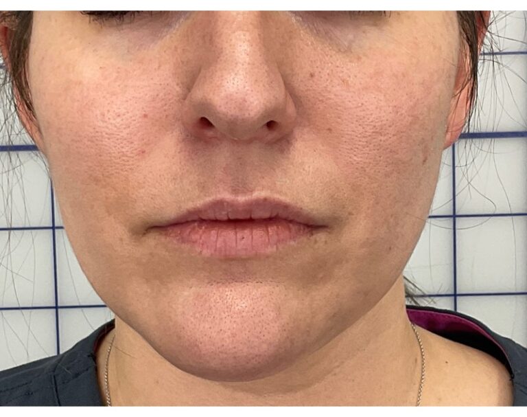 Before Image: Lip Filler - front
