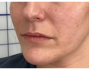 Lip Filler