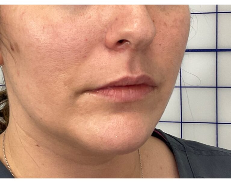 Before Image: Lip Filler - right-front-oblique