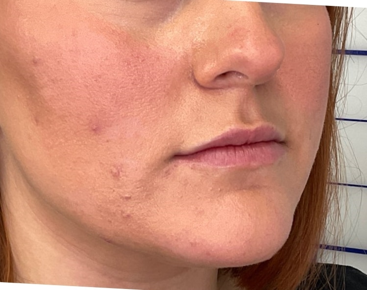 Before Image: Lip Filler - front