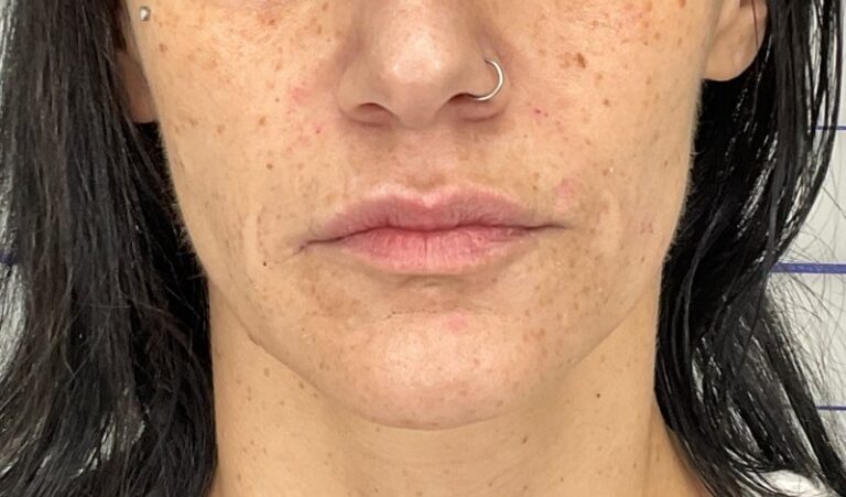 After Image: Smile Line Fillers - front