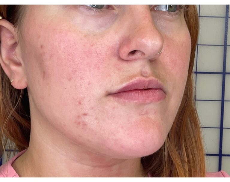 After Image: Lip Filler - front