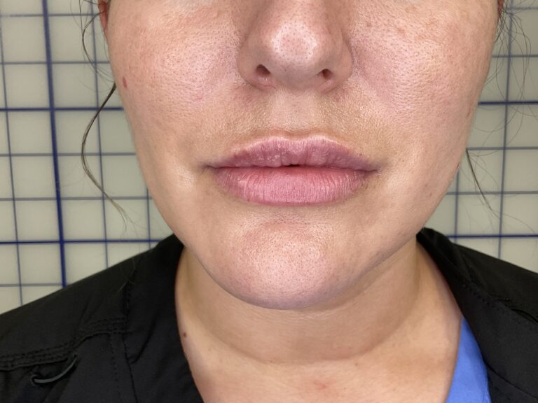 After Image: Lip Filler - front