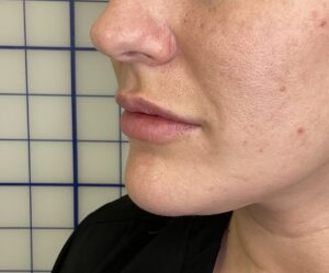 Lip Filler