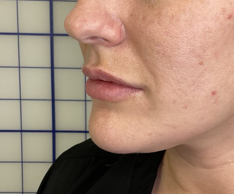 After Image: Lip Filler - left-front-oblique