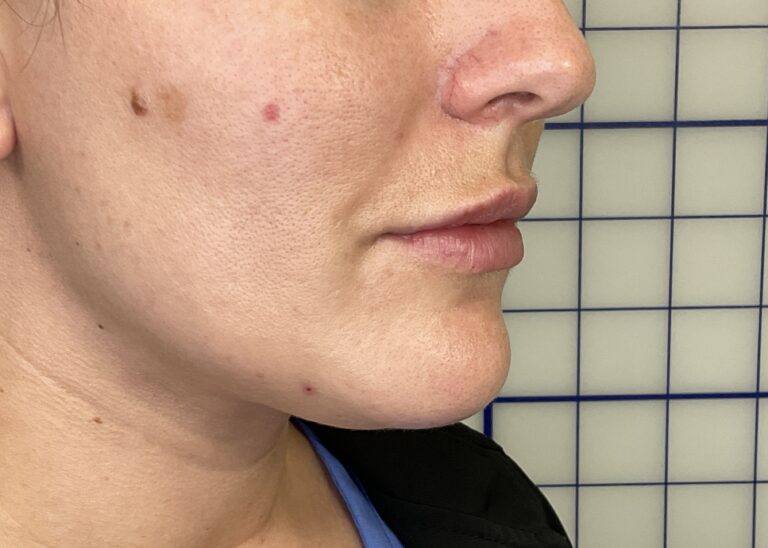 After Image: Lip Filler - right-front-oblique